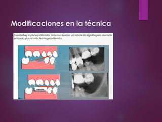 Modificaciones en la técnica
 