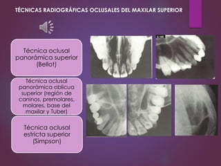 Técnica oclusal
panorámica superior
(Bellot)
Técnica oclusal
panorámica oblicua
superior (región de
caninos, premolares,
molares, base del
maxilar y Tuber)
Técnica oclusal
estricta superior
(Simpson)
TÉCNICAS RADIOGRÁFICAS OCLUSALES DEL MAXILAR SUPERIOR
 