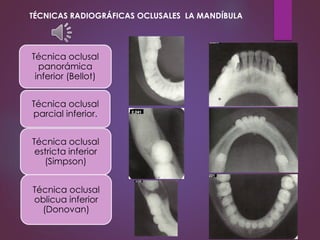 Técnica oclusal
panorámica
inferior (Bellot)
Técnica oclusal
parcial inferior.
Técnica oclusal
estricta inferior
(Simpson)
Técnica oclusal
oblicua inferior
(Donovan)
TÉCNICAS RADIOGRÁFICAS OCLUSALES LA MANDÍBULA
 