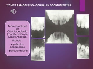 Técnica oclusal
en
Odontopediatría
(modificación de
Casati Alvares).
Usando :
4 películas
periapicales
1 película oclusal
TÉCNICA RADIOGRÁFICA OCLUSAL EN ODONTOPEDIATRÍA:
 