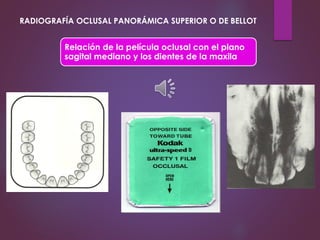 Relación de la película oclusal con el plano
sagital mediano y los dientes de la maxila
RADIOGRAFÍA OCLUSAL PANORÁMICA SUPERIOR O DE BELLOT
 