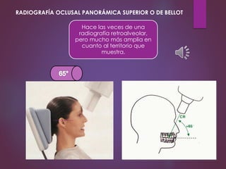 Hace las veces de una
radiografía retroalveolar,
pero mucho más amplia en
cuanto al territorio que
muestra.
RADIOGRAFÍA OCLUSAL PANORÁMICA SUPERIOR O DE BELLOT
 