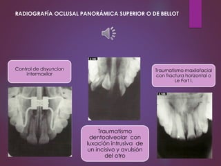 Traumatismo
dentoalveolar con
luxación intrusiva de
un incisivo y avulsión
del otro
Traumatismo maxilofacial
con fractura horizontal o
Le Fort l.
RADIOGRAFÍA OCLUSAL PANORÁMICA SUPERIOR O DE BELLOT
Control de disyuncion
intermaxilar
 