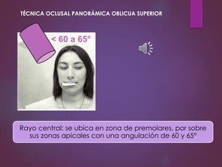 Rayo central: se ubica en zona de premolares, por sobre
sus zonas apicales con una angulación de 60 y 65°
TÉCNICA OCLUSAL PANORÁMICA OBLICUA SUPERIOR
< 60 a 65°
 