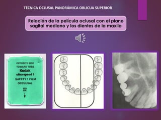 Relación de la película oclusal con el plano
sagital mediano y los dientes de la maxila
TÉCNICA OCLUSAL PANORÁMICA OBLICUA SUPERIOR
 