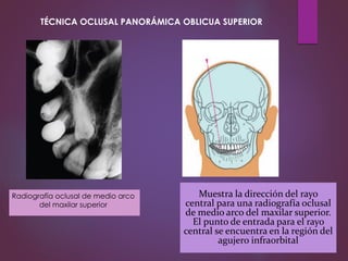 Radiografía oclusal de medio arco
del maxilar superior
Muestra la dirección del rayo
central para una radiografía oclusal
de medio arco del maxilar superior.
El punto de entrada para el rayo
central se encuentra en la región del
agujero infraorbital
TÉCNICA OCLUSAL PANORÁMICA OBLICUA SUPERIOR
 
