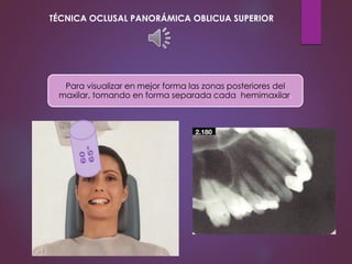 Para visualizar en mejor forma las zonas posteriores del
maxilar, tomando en forma separada cada hemimaxilar.
TÉCNICA OCLUSAL PANORÁMICA OBLICUA SUPERIOR
 