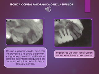 Implantes de gran longitud en
zona de molares y premolares.
Canino superior incluido, cuya raíz
se proyecta a la altura del primer
y segundo premolares, además se
aprecia extensa lesión quística en
la zona periapical de los incisivos
lateral y central.
TÉCNICA OCLUSAL PANORÁMICA OBLICUA SUPERIOR
 