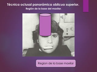 Técnica oclusal panorámica oblicua superior.
Región de la base del maxilar.
Region de la base maxilar
 