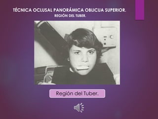 Región del Tuber.
TÉCNICA OCLUSAL PANORÁMICA OBLICUA SUPERIOR.
REGIÓN DEL TUBER.
 