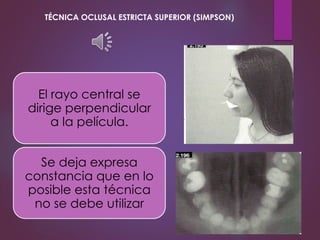 El rayo central se
dirige perpendicular
a la película.
Se deja expresa
constancia que en lo
posible esta técnica
no se debe utilizar
TÉCNICA OCLUSAL ESTRICTA SUPERIOR (SIMPSON)
 
