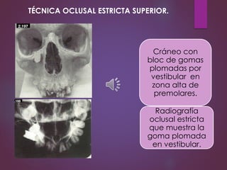 Cráneo con
bloc de gomas
plomadas por
vestibular en
zona alta de
premolares.
Radiografía
oclusal estricta
que muestra la
goma plomada
en vestibular.
TÉCNICA OCLUSAL ESTRICTA SUPERIOR.
 