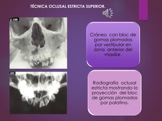 Cráneo con bloc de
gomas plomadas
por vestibular en
zona anterior del
maxilar.
Radiografía oclusal
estricta mostrando la
proyección del bloc
de gomas plomadas
por palatino.
TÉCNICA OCLUSAL ESTRICTA SUPERIOR.
 