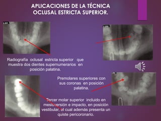 APLICACIONES DE LA TÉCNICA
OCLUSAL ESTRICTA SUPERIOR.
Radiografía oclusal estricta superior que
muestra dos dientes supernumerarios en
posición palatina.
Tercer molar superior incluido en
mesioversión e impacto, en posición
vestibular, el cual además presenta un
quiste pericoronario.
Premolares superiores con
sus coronas en posición
palatina.
 