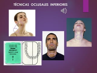 TÉCNICAS OCLUSALES INFERIORES
 