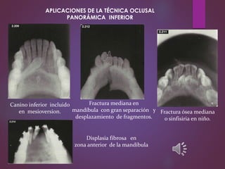 Canino inferior incluido
en mesioversion.
Displasia fibrosa en
zona anterior de la mandíbula
Fractura ósea mediana
o sinfisiria en niño.
Fractura mediana en
mandíbula con gran separación y
desplazamiento de fragmentos.
APLICACIONES DE LA TÉCNICA OCLUSAL
PANORÁMICA INFERIOR
 
