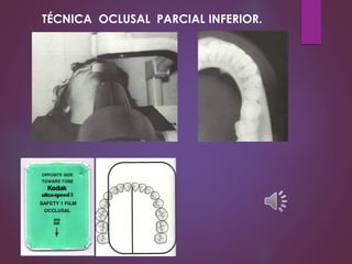 TÉCNICA OCLUSAL PARCIAL INFERIOR.
 