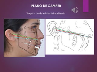 Tragus – borde inferior infraorbitario
PLANO DE CAMPER
 