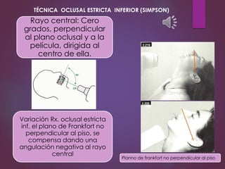 Rayo central: Cero
grados, perpendicular
al plano oclusal y a la
película, dirigida al
centro de ella.
Variación Rx. oclusal estricta
inf, el plano de Frankfort no
perpendicular al piso, se
compensa dando una
angulación negativa al rayo
central
Planno de frankfort no perpendicular al piso
TÉCNICA OCLUSAL ESTRICTA INFERIOR (SIMPSON)
 