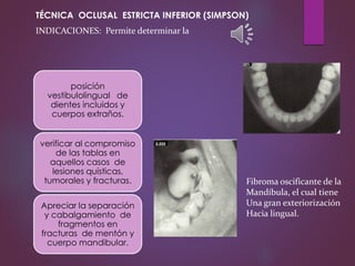 posición
vestibulolingual de
dientes incluidos y
cuerpos extraños.
verificar al compromiso
de las tablas en
aquellos casos de
lesiones quísticas,
tumorales y fracturas.
Apreciar la separación
y cabalgamiento de
fragmentos en
fracturas de mentón y
cuerpo mandibular.
INDICACIONES: Permite determinar la
Fibroma oscificante de la
Mandíbula, el cual tiene
Una gran exteriorización
Hacia lingual.
TÉCNICA OCLUSAL ESTRICTA INFERIOR (SIMPSON)
 