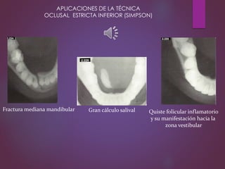 Fractura mediana mandibular Quiste folicular inflamatorio
y su manifestación hacia la
zona vestibular
Gran cálculo salival
APLICACIONES DE LA TÉCNICA
OCLUSAL ESTRICTA INFERIOR (SIMPSON)
 