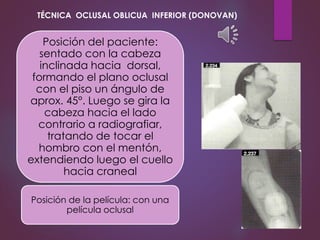 •Exis
Posición del paciente:
sentado con la cabeza
inclinada hacia dorsal,
formando el plano oclusal
con el piso un ángulo de
aprox. 45°. Luego se gira la
cabeza hacia el lado
contrario a radiografiar,
tratando de tocar el
hombro con el mentón,
extendiendo luego el cuello
hacia craneal
Posición de la película: con una
película oclusal
TÉCNICA OCLUSAL OBLICUA INFERIOR (DONOVAN)
 
