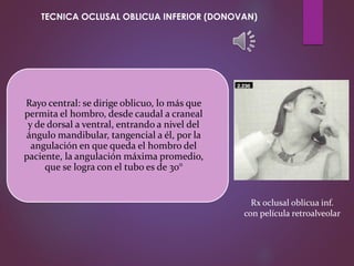 Rayo central: se dirige oblicuo, lo más que
permita el hombro, desde caudal a craneal
y de dorsal a ventral, entrando a nivel del
ángulo mandibular, tangencial a él, por la
angulación en que queda el hombro del
paciente, la angulación máxima promedio,
que se logra con el tubo es de 30°
Rx oclusal oblicua inf.
con película retroalveolar
TECNICA OCLUSAL OBLICUA INFERIOR (DONOVAN)
 