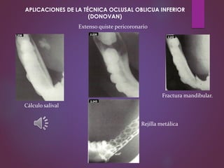 Cálculo salival
Extenso quiste pericoronario
Fractura mandibular.
Rejilla metálica
APLICACIONES DE LA TÉCNICA OCLUSAL OBLICUA INFERIOR
(DONOVAN)
 