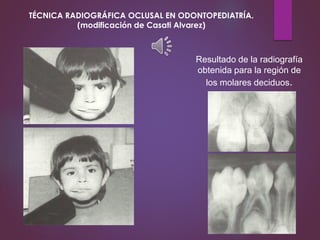 Resultado de la radiografía
obtenida para la región de
los molares deciduos.
TÉCNICA RADIOGRÁFICA OCLUSAL EN ODONTOPEDIATRÍA.
(modificación de Casati Alvarez)
 