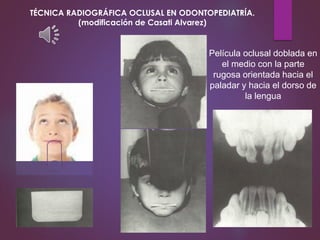 Película oclusal doblada en
el medio con la parte
rugosa orientada hacia el
paladar y hacia el dorso de
la lengua
TÉCNICA RADIOGRÁFICA OCLUSAL EN ODONTOPEDIATRÍA.
(modificación de Casati Alvarez)
 