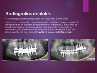 Radiografías dentales
 Las radiografías dentales pueden ser: Extraorales e intra orales
- Extraorales: con aquellas que nos ofrece la posibilidad de ver una película
radiográfica de las arcadas, huesos maxilares, mandíbula y estructuras de
soporte, siendo una herramienta ideal para valorar la posición de los
dientes así como para observar las lesiones que se desarrollan fuera del
espacio peridental tales como los quistes o tumores odontogénicos.
 