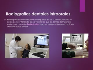 Radiografías dentales intraorales
 Radiografías intraorales: que son aquellas en las cuales la película se
coloca en el interior del boca y entre las que podemos distinguir de
varios tipos como las Periapicales, que nos muestran la corona, raíz y el
área del ápice diente.
 