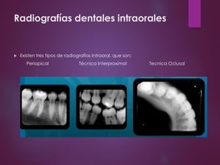 Radiografías dentales intraorales
 Existen tres tipos de radiografías intraoral, que son:
Periapical Técnica Interproximal Tecnica Oclusal
 