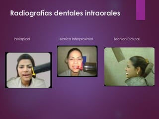 Radiografías dentales intraorales
Periapical Técnica Interproximal Tecnica Oclusal
 