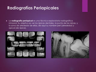 Radiografías Periapicales
 La radiografía periapical es una técnica exploratoria radiográfica
intraoral. Su objetivo es ver los ápices dentales, la punta de las raíces, y
la zona de alrededor de ellos, de aquí su nombre peri (alrededor) y
apical (de ápice).
 