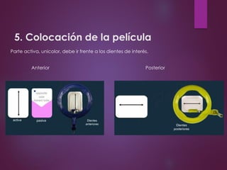 5. Colocación de la película
Parte activa, unicolor, debe ir frente a los dientes de interés.
Anterior Posterior
 
