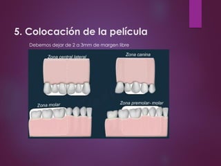 5. Colocación de la película
Debemos dejar de 2 a 3mm de margen libre
 