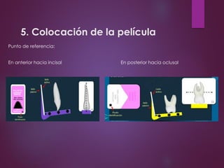 5. Colocación de la película
Punto de referencia:
En anterior hacia incisal En posterior hacia oclusal
 