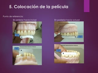 5. Colocación de la película
Punto de referencia:
En anterior hacia incisal En posterior hacia oclusal
 