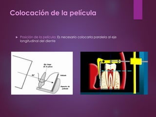 Colocación de la película
 Posición de la película: Es necesario colocarla paralela al eje
longitudinal del diente
 