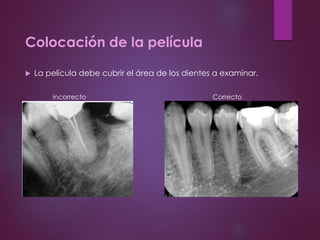 Colocación de la película
 La película debe cubrir el área de los dientes a examinar.
incorrecto Correcto
 