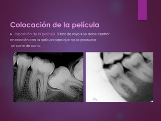 Colocación de la película
 Exposición de la película: El haz de rayo X se debe centrar
en relación con la película para que no se produzca
un corte de cono.
 