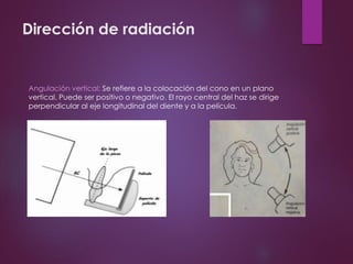 Dirección de radiación
Angulación vertical: Se refiere a la colocación del cono en un plano
vertical. Puede ser positivo o negativo. El rayo central del haz se dirige
perpendicular al eje longitudinal del diente y a la película.
 