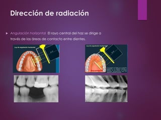 Dirección de radiación
 Angulación horizontal: El rayo central del haz se dirige a
través de las áreas de contacto entre dientes.
 
