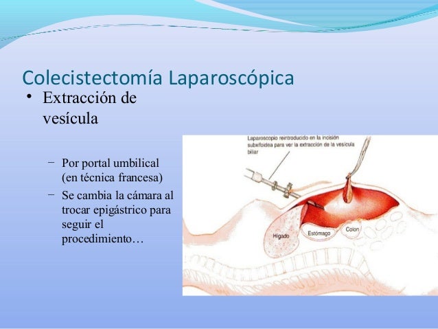 Tecnica colecistectomía laparoscópica