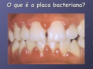 O que é a placa bacteriana? 