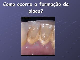 Como ocorre a formação da placa? 
