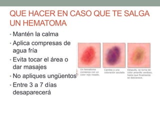 QUE HACER EN CASO QUE TE SALGA
UN HEMATOMA
• Mantén la calma
• Aplica compresas de
agua fría
• Evita tocar el área o
dar masajes
• No apliques ungüentos
• Entre 3 a 7 días
desaparecerá
 