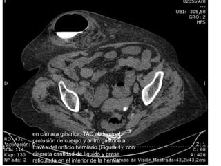 en cámara gástrica. TAC abdominal:
protusión de cuerpo y antro gástrico a
través del orificio herniario (Figura 1), con
discreta cantidad de líquido y grasa
reticulada en el interior de la hernia.
 