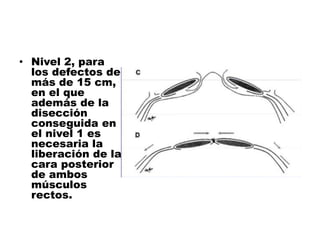 • Nivel 2, para
los defectos de
más de 15 cm,
en el que
además de la
disección
conseguida en
el nivel 1 es
necesaria la
liberación de la
cara posterior
de ambos
músculos
rectos.
 